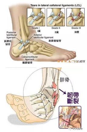 踝关节扭伤的诊断及治疗方法，看这篇就够了！