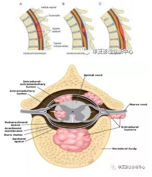 椎管内肿瘤分类图片