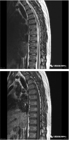 脊髓内最常见的肿瘤就这三种，如何诊断？