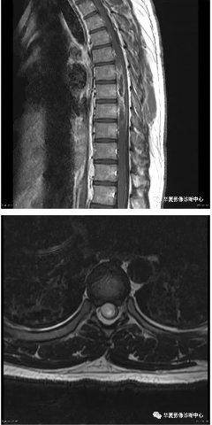 脊髓内最常见的肿瘤就这三种，如何诊断？