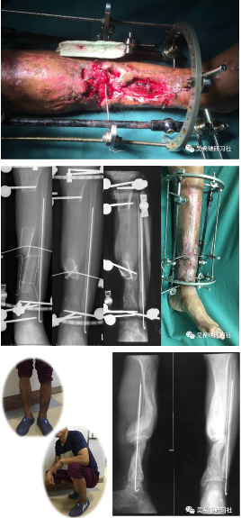 骨水泥技术在创伤骨科中的应用，你了解吗？