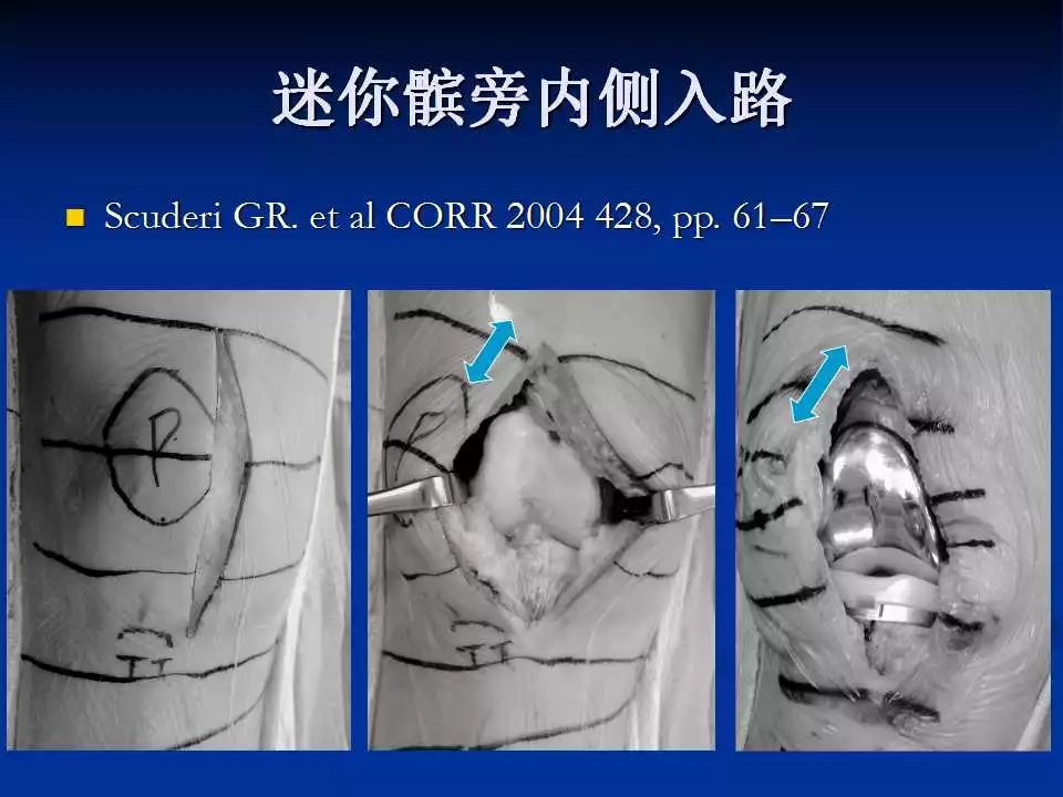 一篇掌握：小切口和微创全膝置换术