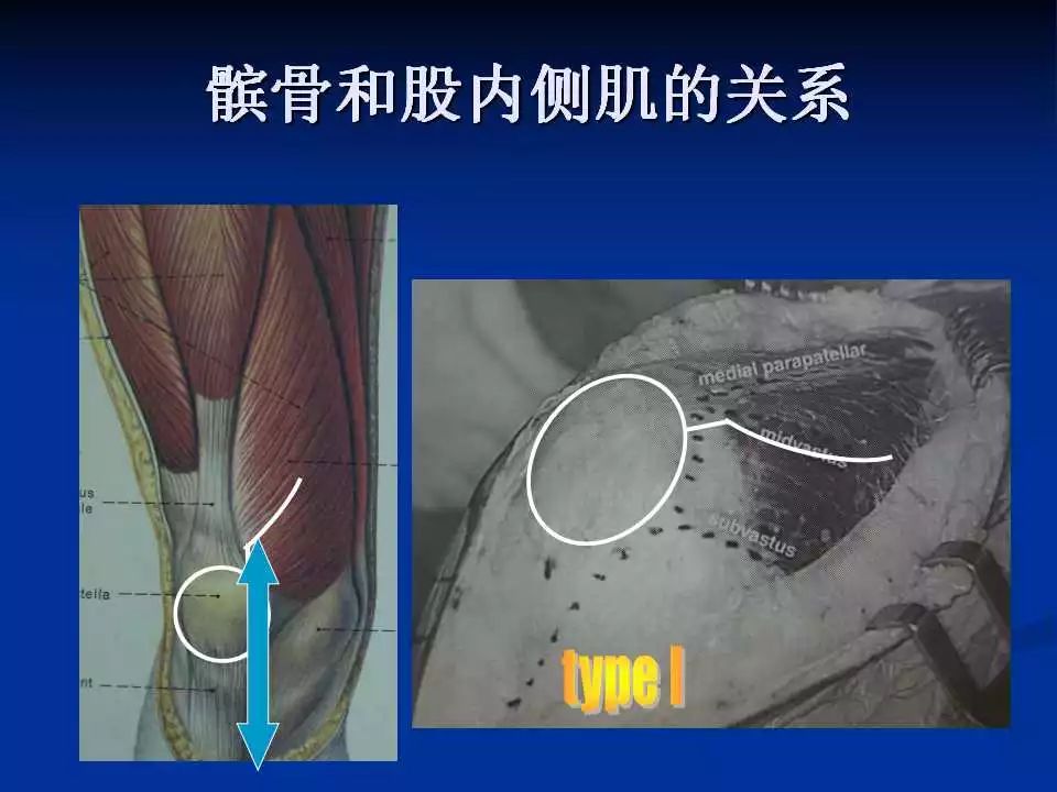 一篇掌握：小切口和微创全膝置换术