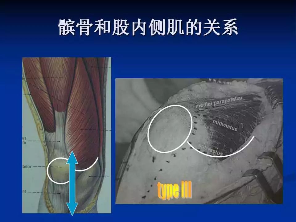 一篇掌握：小切口和微创全膝置换术