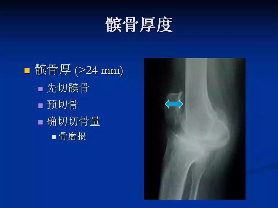 一篇掌握：小切口和微创全膝置换术