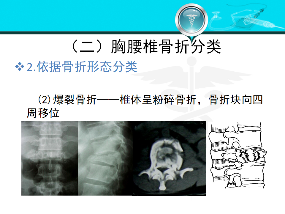 一篇掌握：脊柱、脊髓损伤的分类及治疗原则