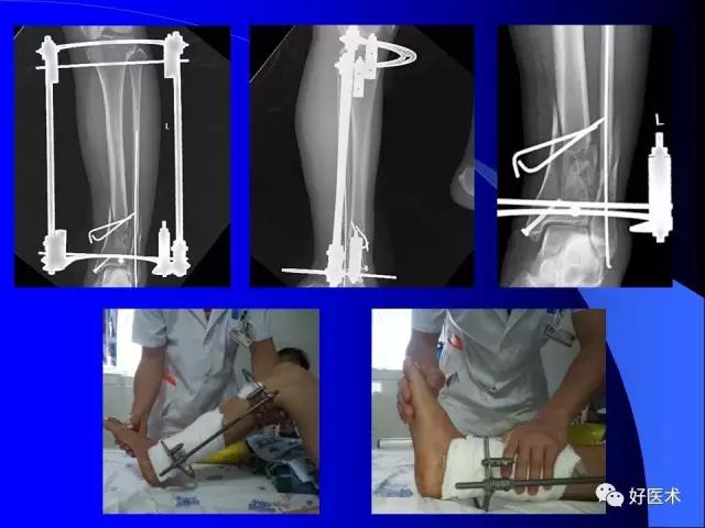 经皮器械复位方法在创伤骨折中的应用
