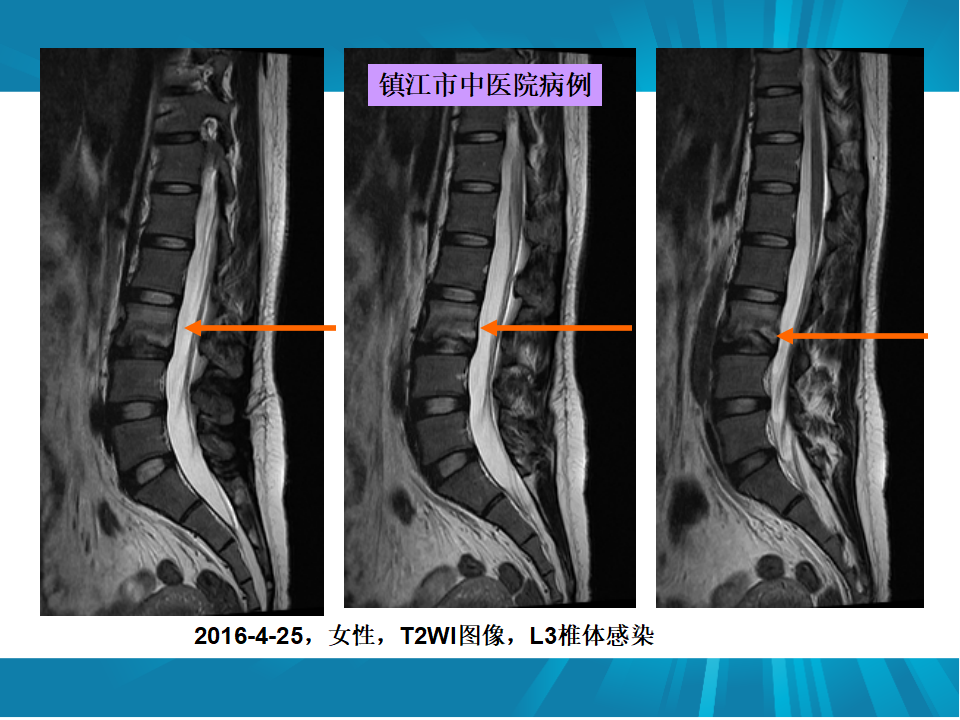 脊柱常见疾病的MRI诊断技巧，都在这篇课件里！