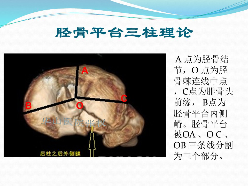 一篇掌握：后方入路治疗胫骨平台骨折