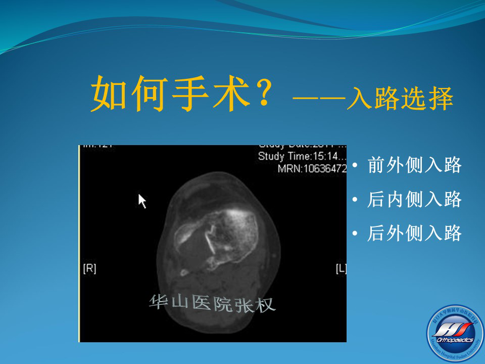 一篇掌握：后方入路治疗胫骨平台骨折