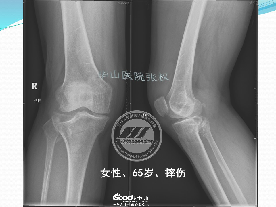 一篇掌握：后方入路治疗胫骨平台骨折