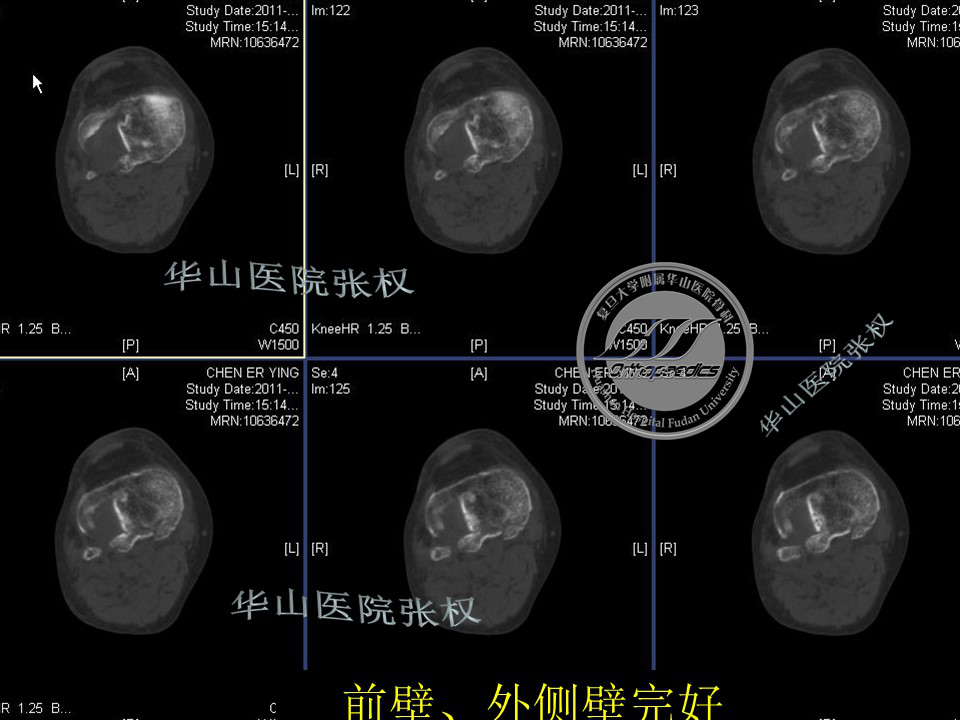 一篇掌握：后方入路治疗胫骨平台骨折