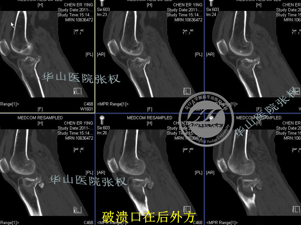 一篇掌握：后方入路治疗胫骨平台骨折