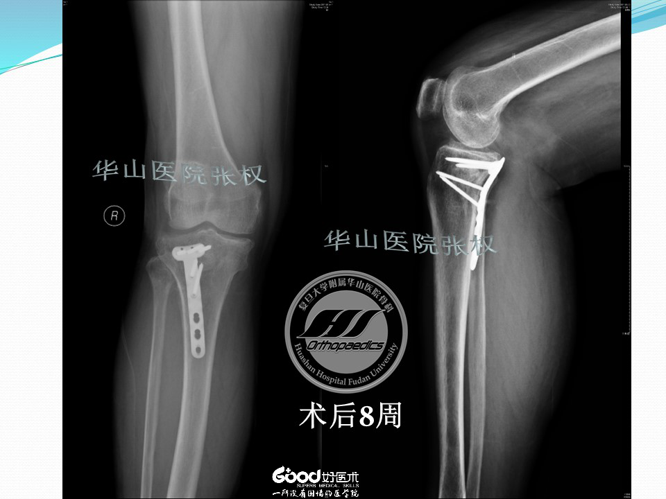 一篇掌握：后方入路治疗胫骨平台骨折