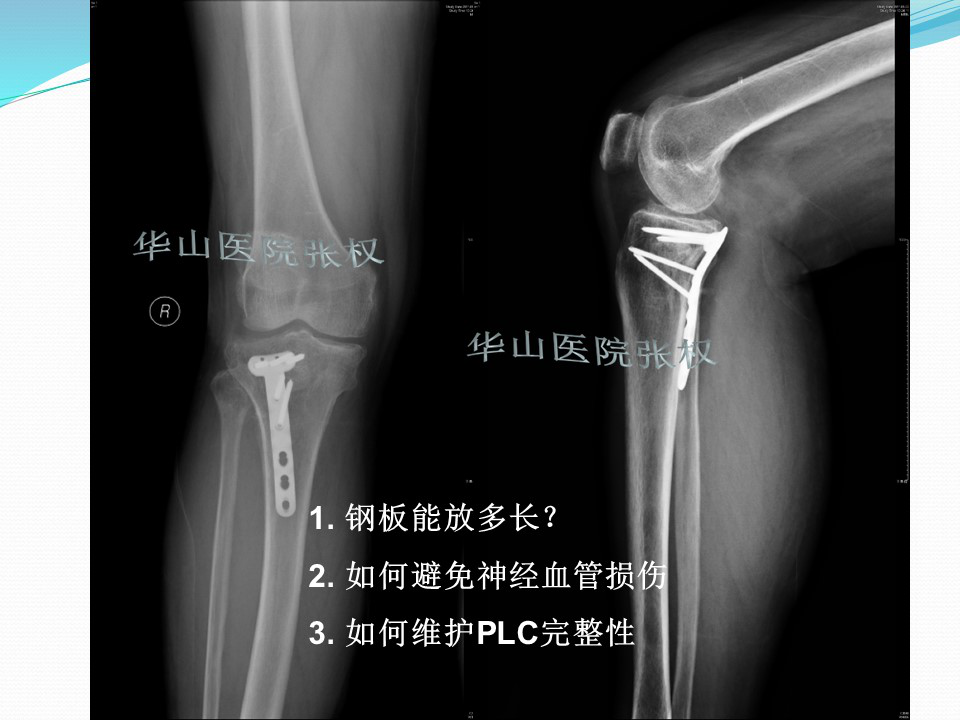 一篇掌握：后方入路治疗胫骨平台骨折