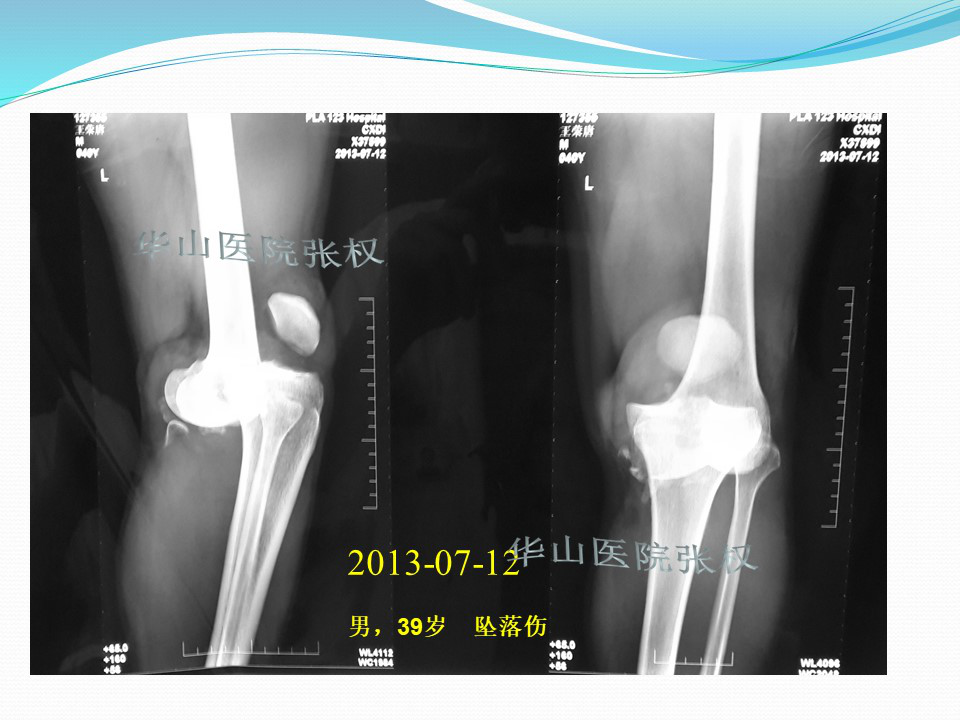 一篇掌握：后方入路治疗胫骨平台骨折