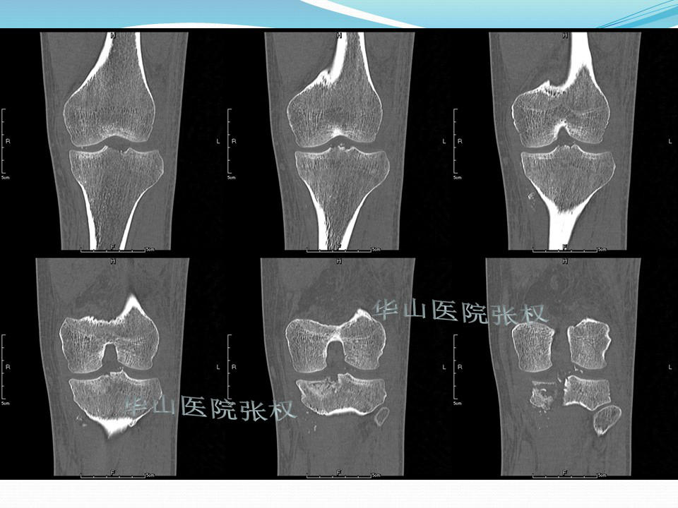 一篇掌握：后方入路治疗胫骨平台骨折