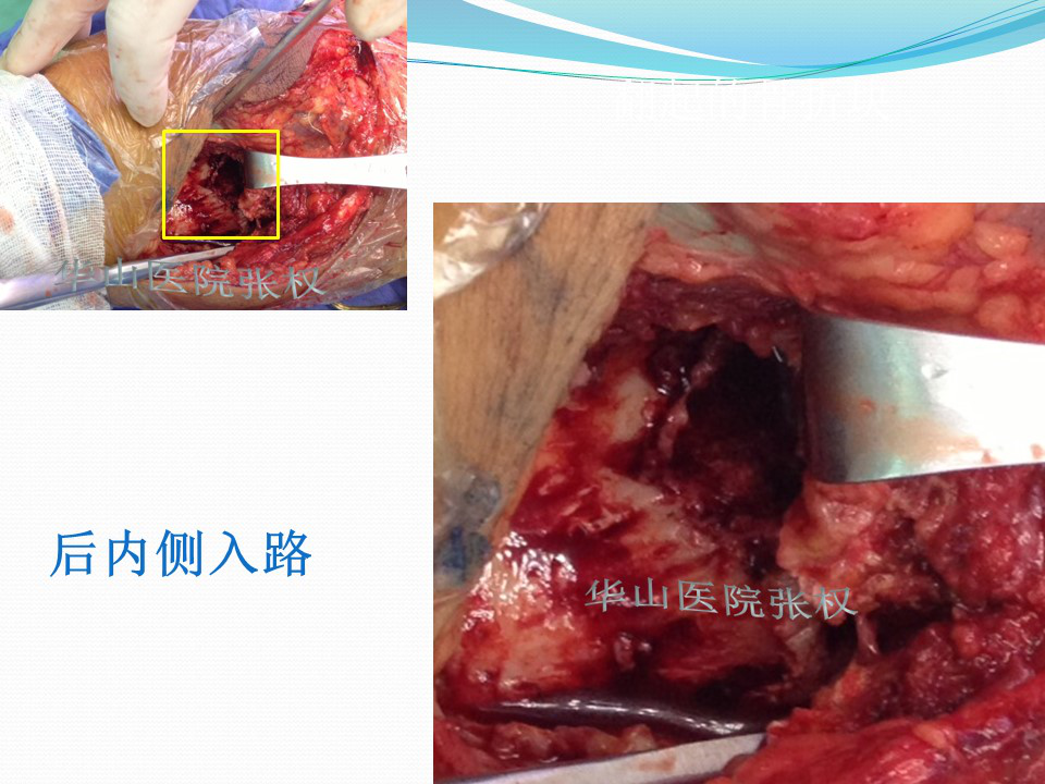 一篇掌握：后方入路治疗胫骨平台骨折