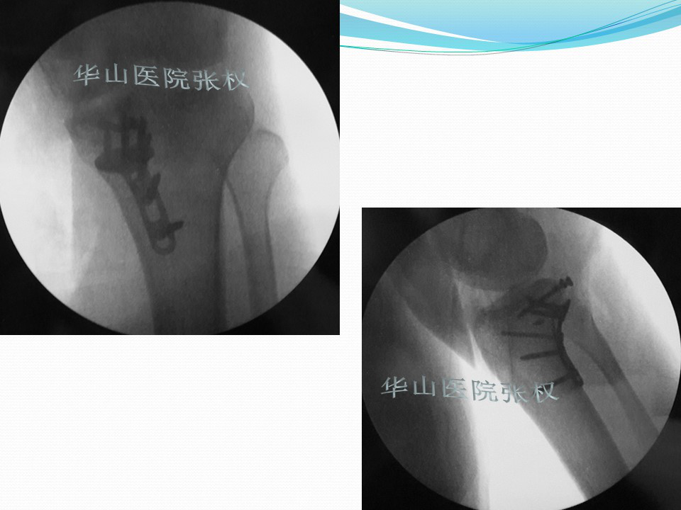 一篇掌握：后方入路治疗胫骨平台骨折