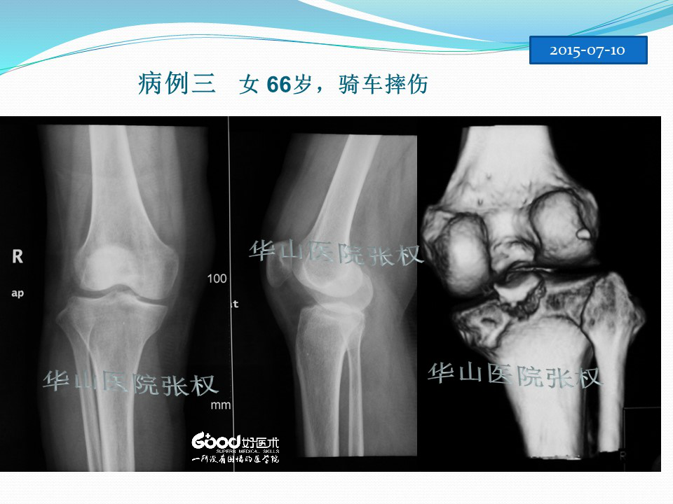 一篇掌握：后方入路治疗胫骨平台骨折