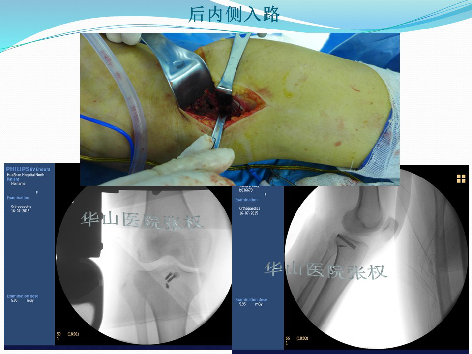 一篇掌握：后方入路治疗胫骨平台骨折