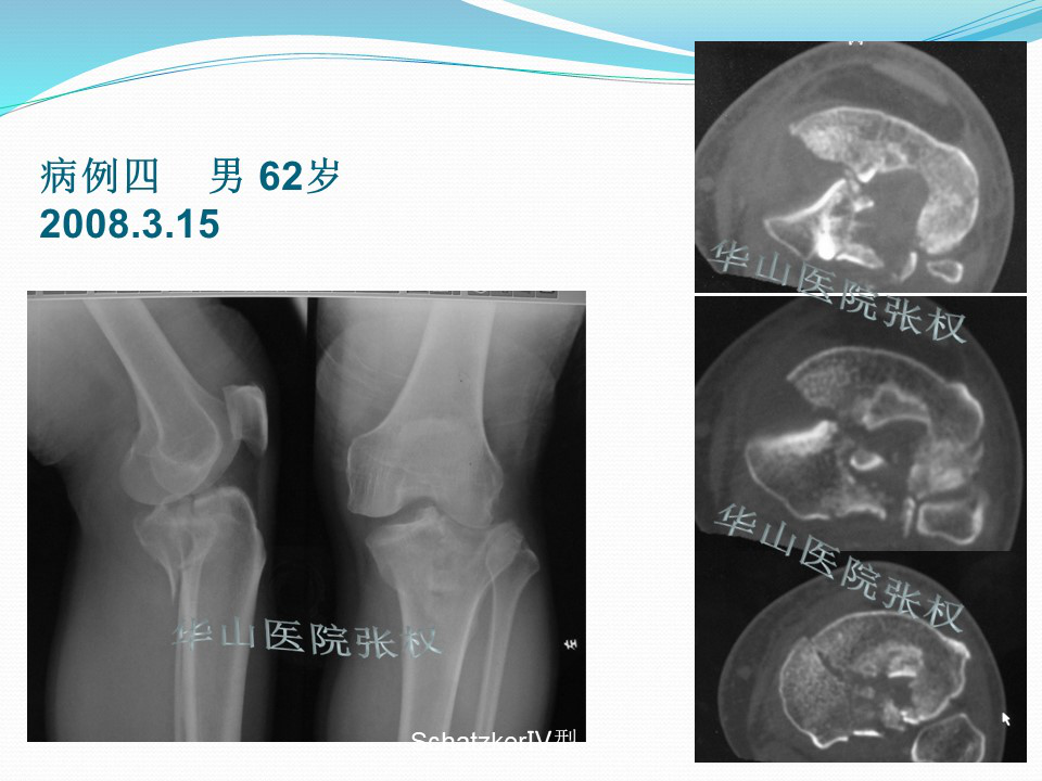 一篇掌握：后方入路治疗胫骨平台骨折