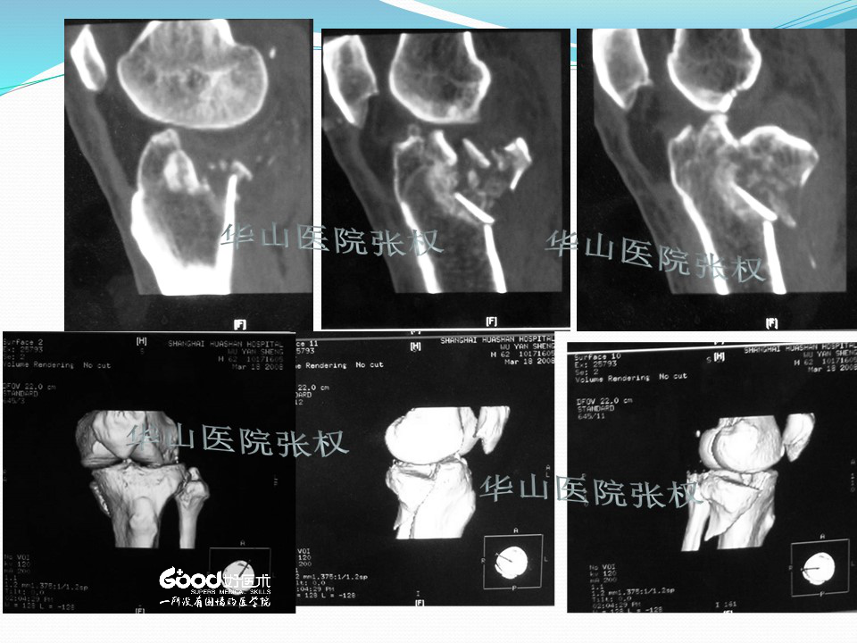 一篇掌握：后方入路治疗胫骨平台骨折