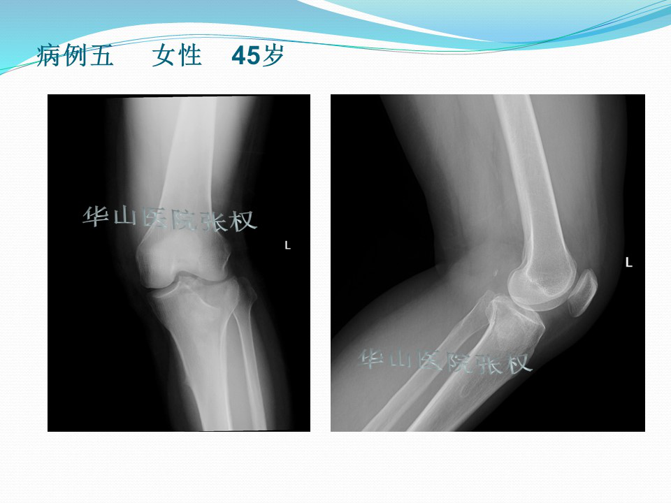 一篇掌握：后方入路治疗胫骨平台骨折