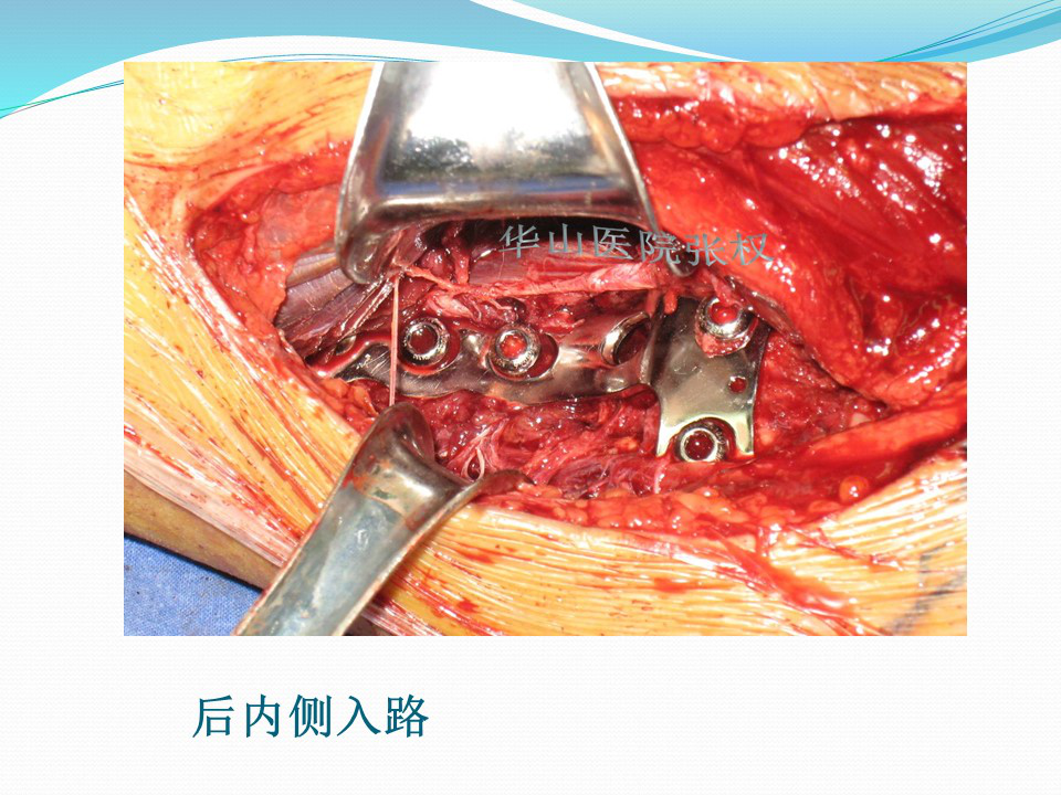 一篇掌握：后方入路治疗胫骨平台骨折