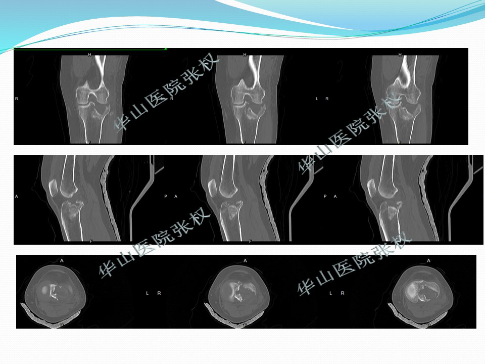 一篇掌握：后方入路治疗胫骨平台骨折