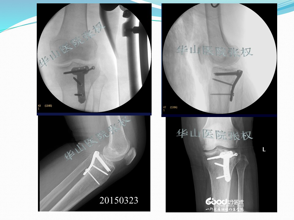 一篇掌握：后方入路治疗胫骨平台骨折