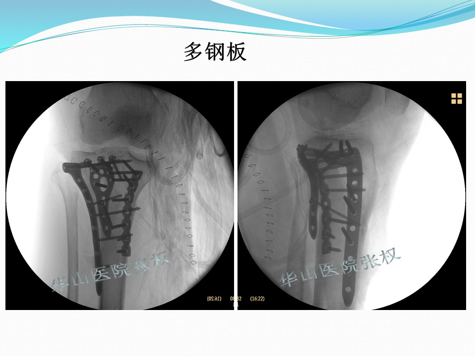 一篇掌握：后方入路治疗胫骨平台骨折