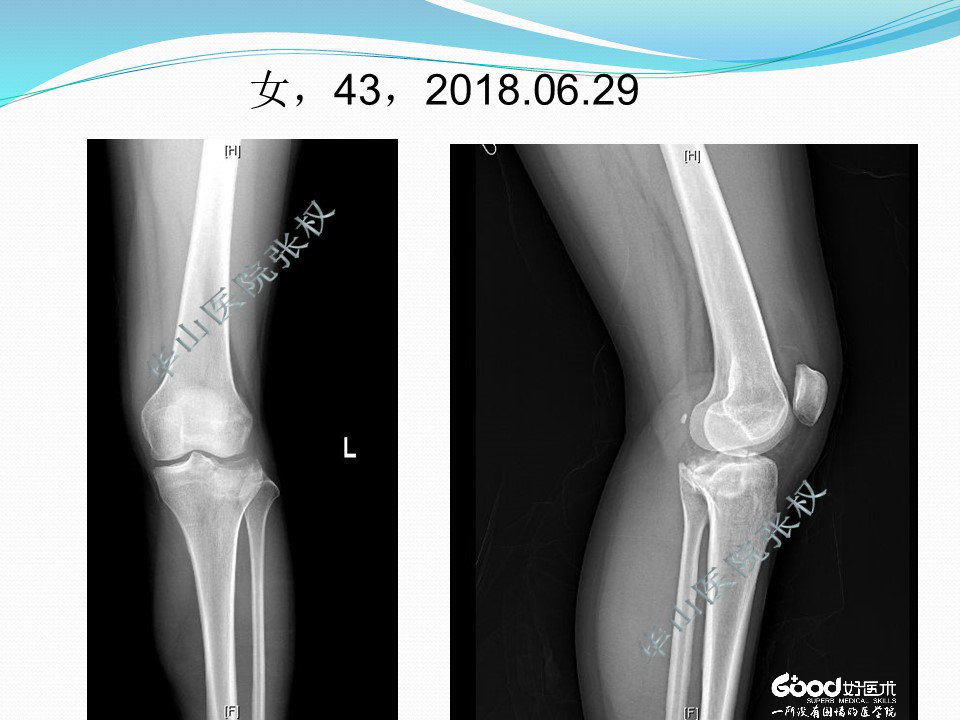 一篇掌握：后方入路治疗胫骨平台骨折