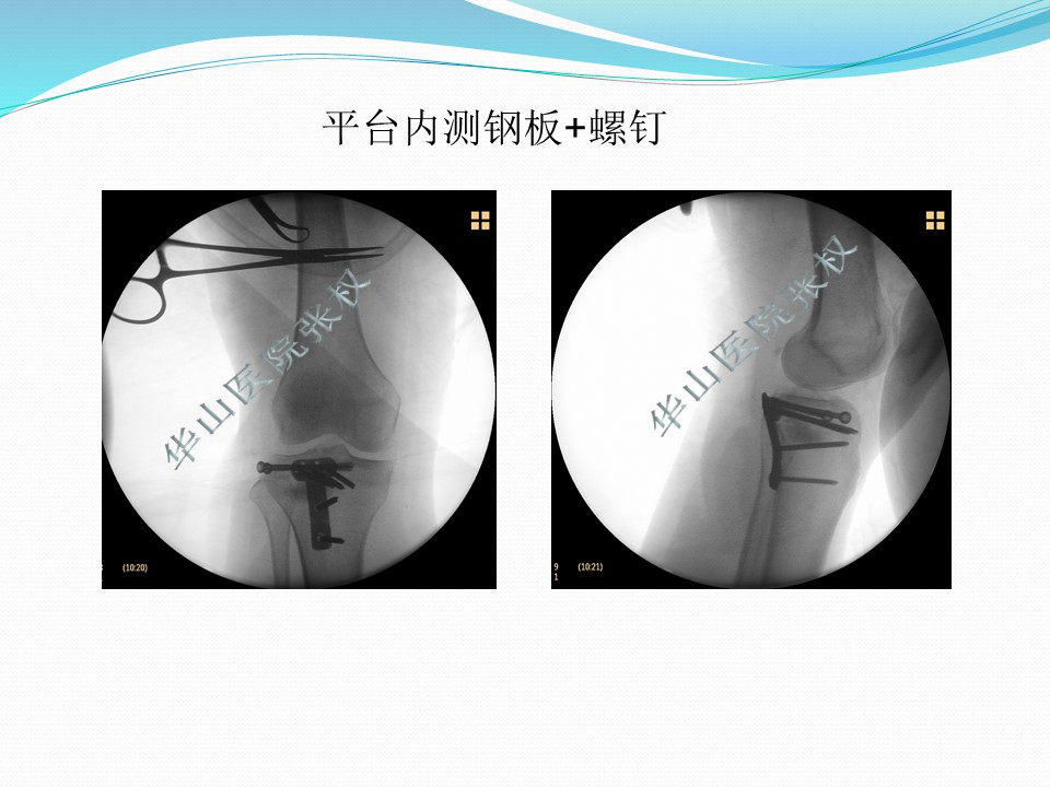 一篇掌握：后方入路治疗胫骨平台骨折