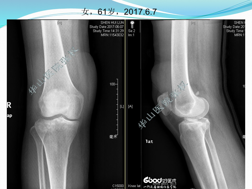 一篇掌握：后方入路治疗胫骨平台骨折