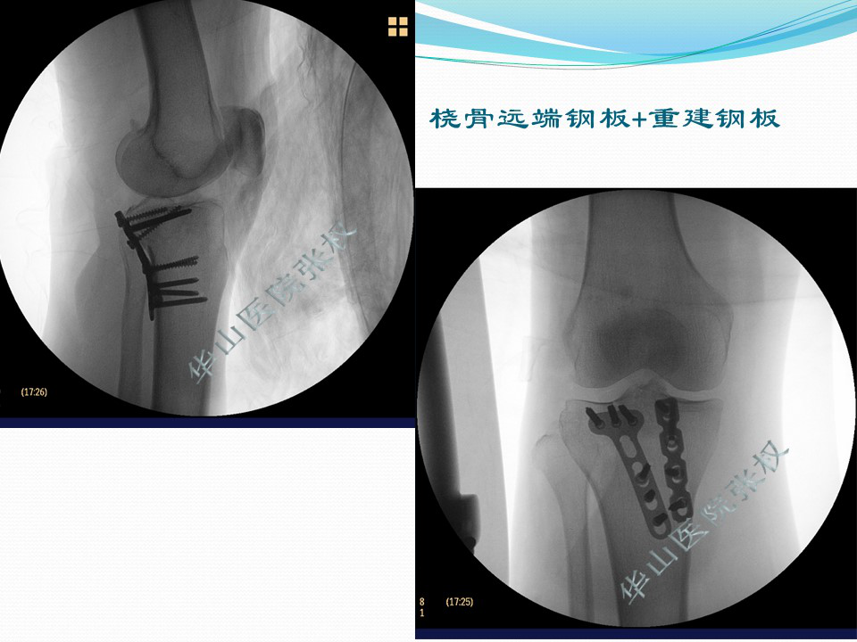 一篇掌握：后方入路治疗胫骨平台骨折