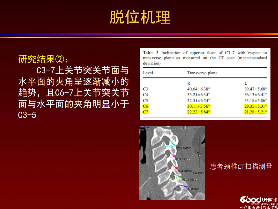 颈椎单侧小关节脱位手术治疗的技术进展