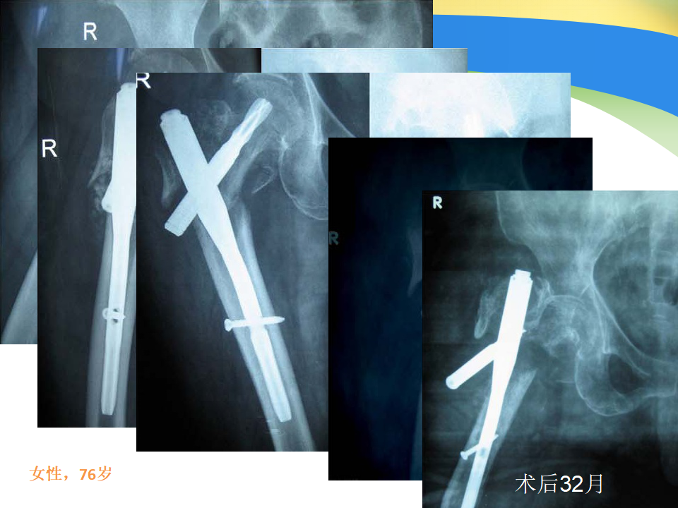 髓内钉治疗股骨近端骨折的要点与手术技巧，详细解析！