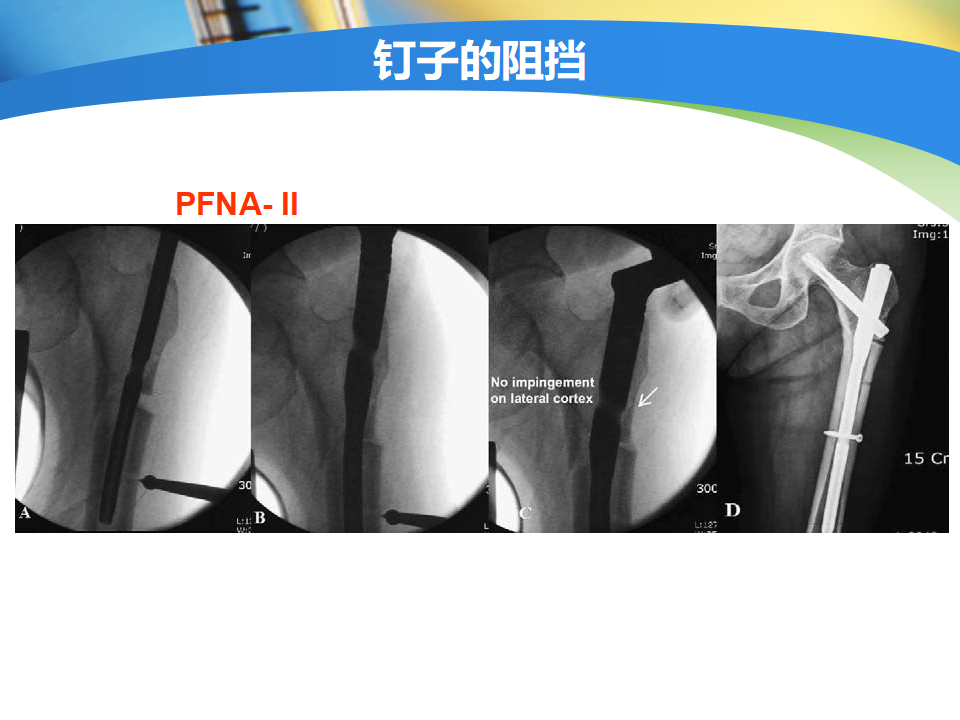 髓内钉治疗股骨近端骨折的要点与手术技巧，详细解析！