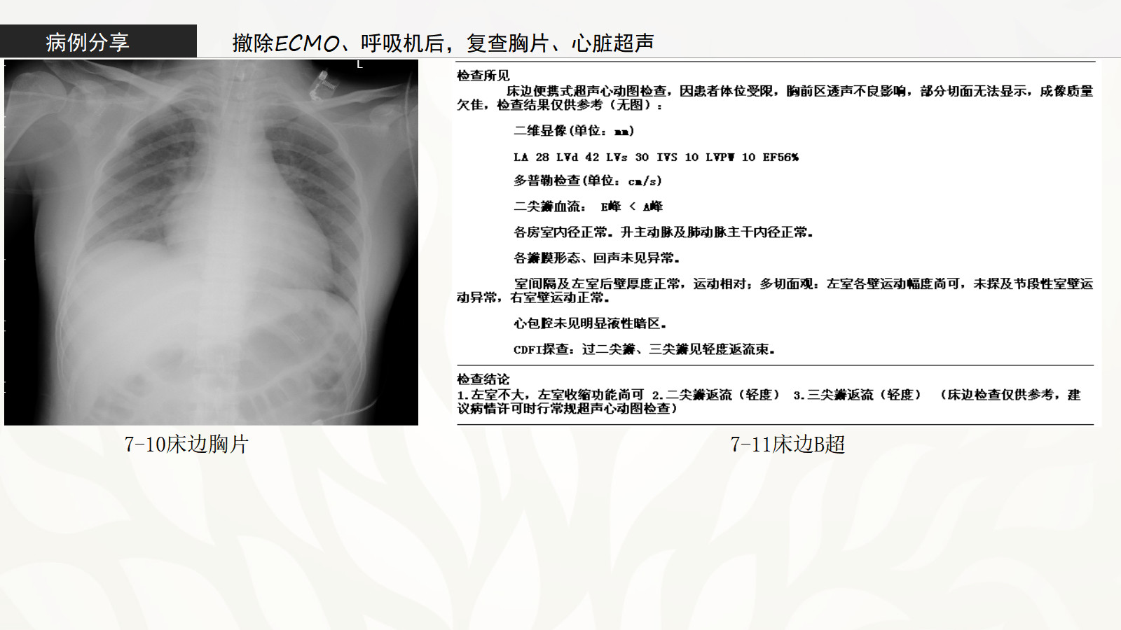 爆发性心肌炎的诊治策略！