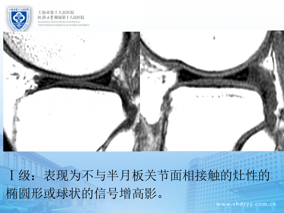 半月板损伤的诊治技巧，看完这篇就够了！