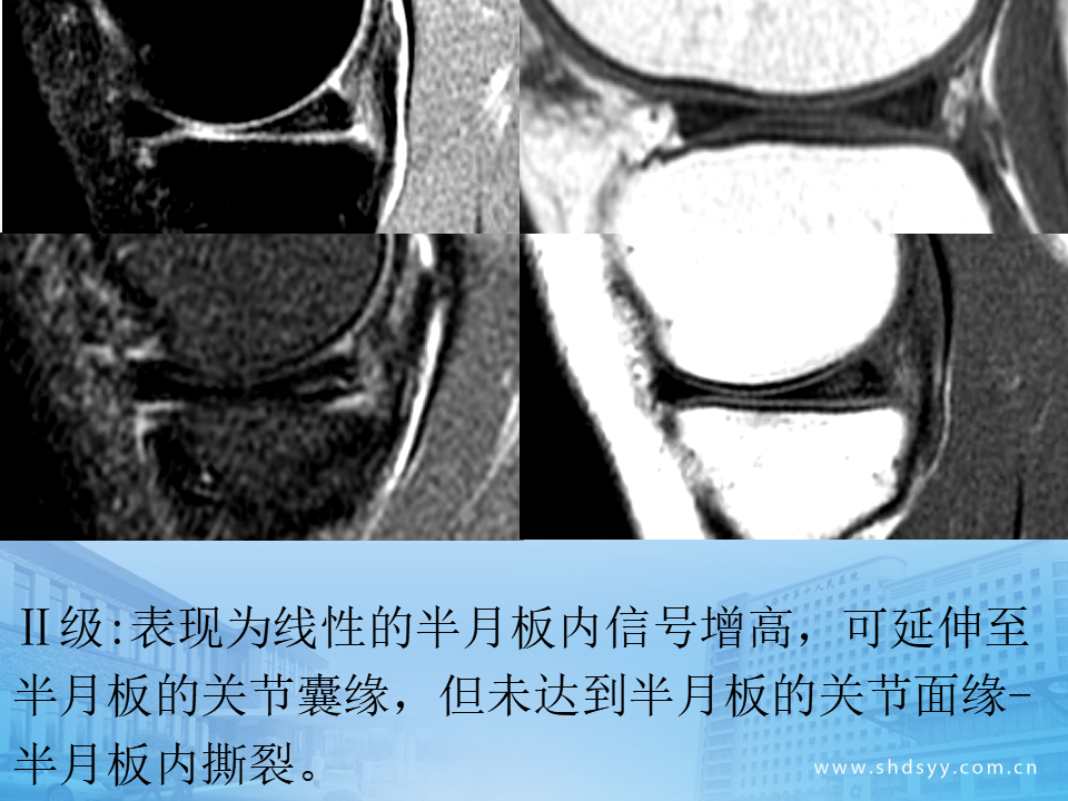 半月板损伤的诊治技巧，看完这篇就够了！