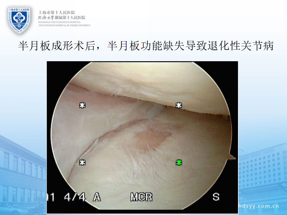 半月板损伤的诊治技巧，看完这篇就够了！