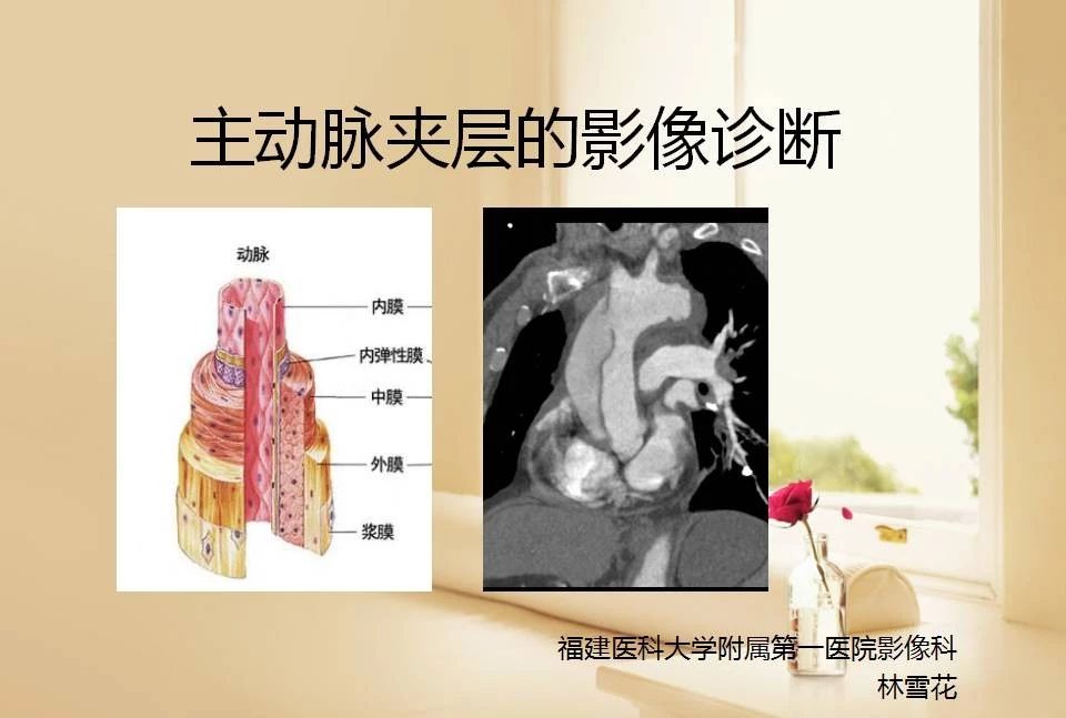 主动脉夹层的影像诊断，这样鉴别更简单！