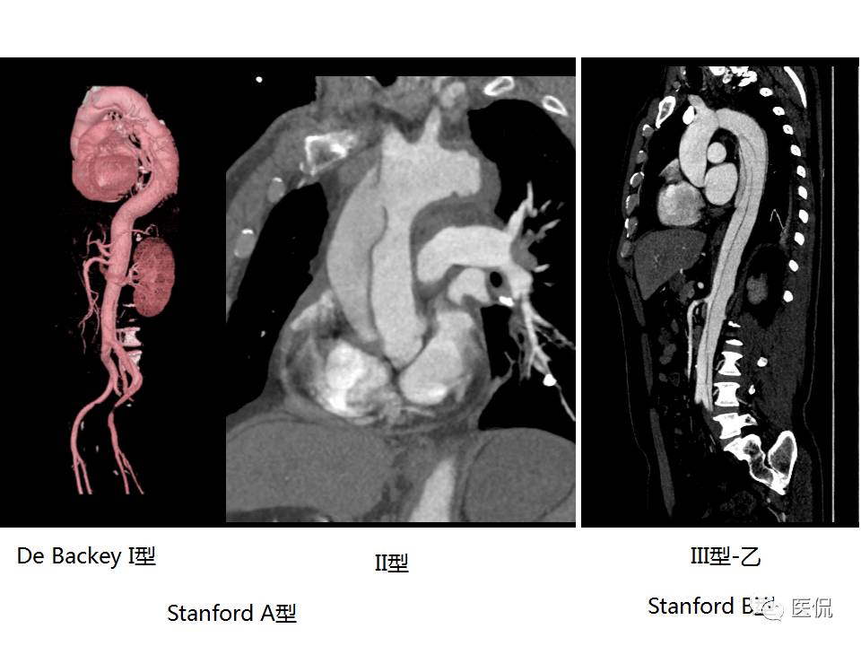 主动脉夹层的影像诊断，这样鉴别更简单！