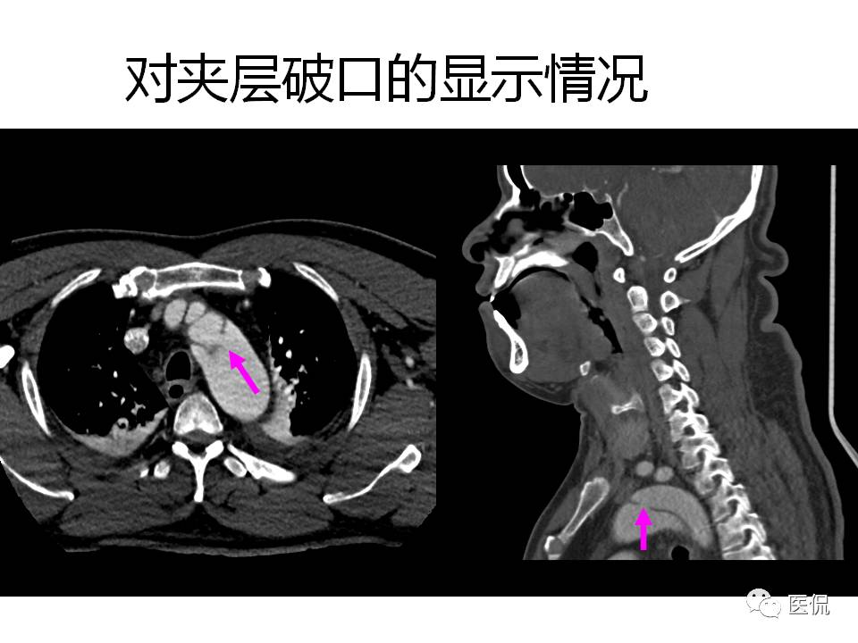 主动脉夹层的影像诊断，这样鉴别更简单！