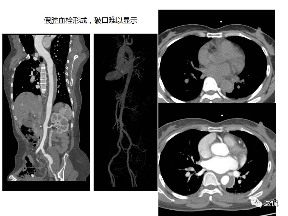 主动脉夹层的影像诊断，这样鉴别更简单！