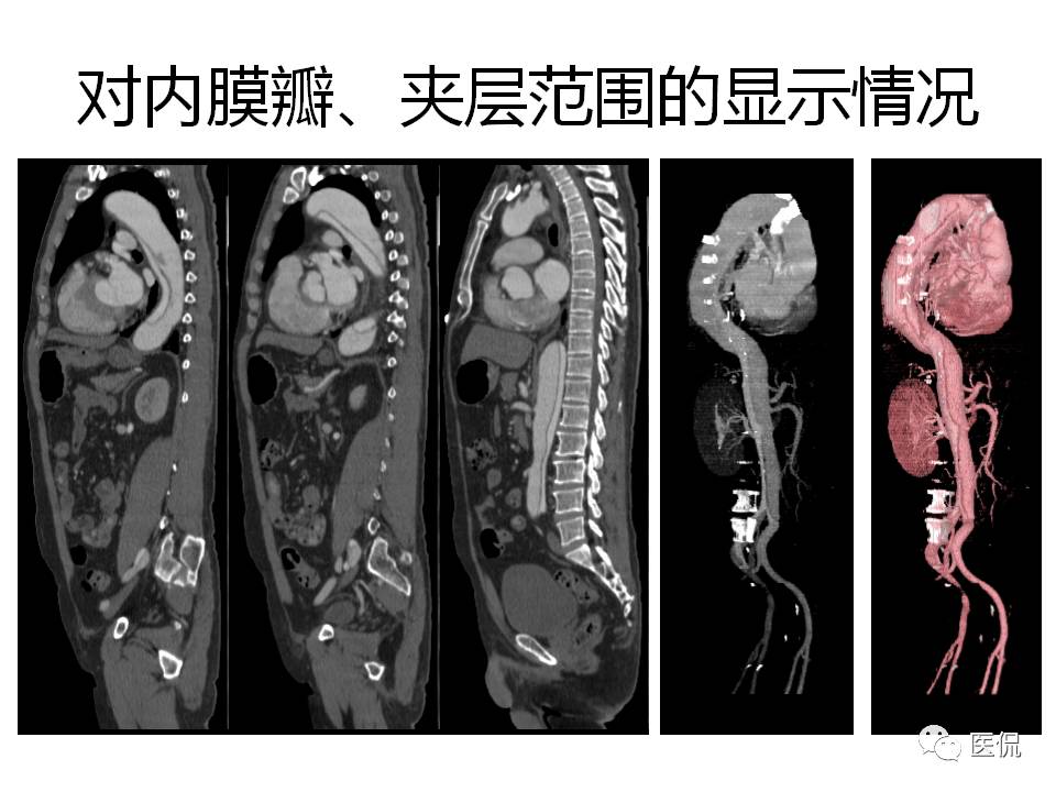 主动脉夹层的影像诊断，这样鉴别更简单！