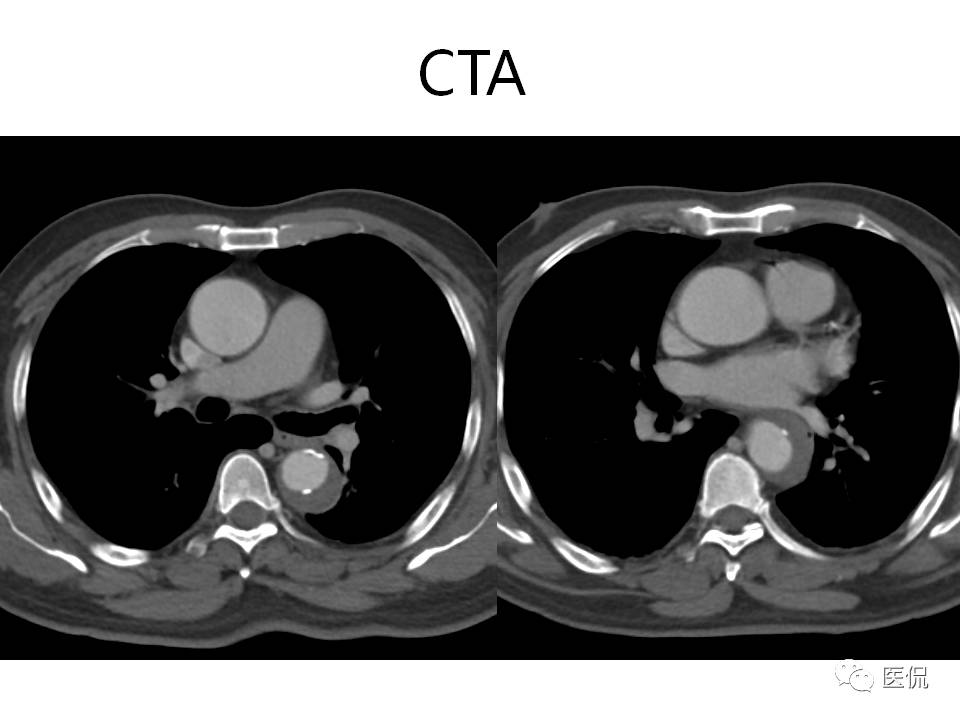 主动脉夹层的影像诊断，这样鉴别更简单！