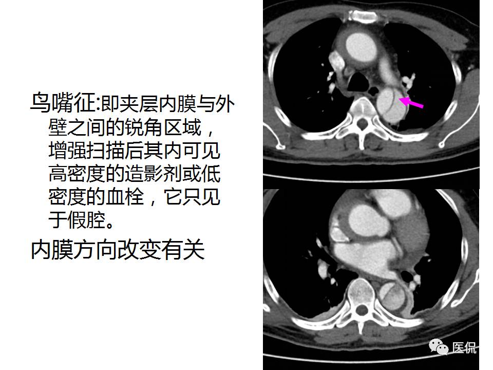 主动脉夹层的影像诊断，这样鉴别更简单！